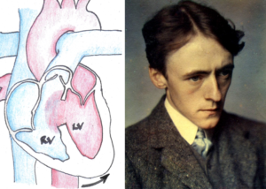 palpitations caused by high pressure blood